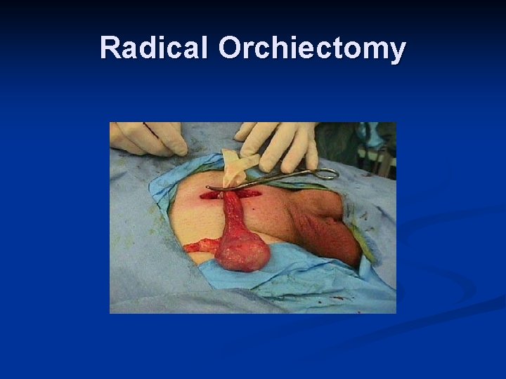 Radical Orchiectomy 