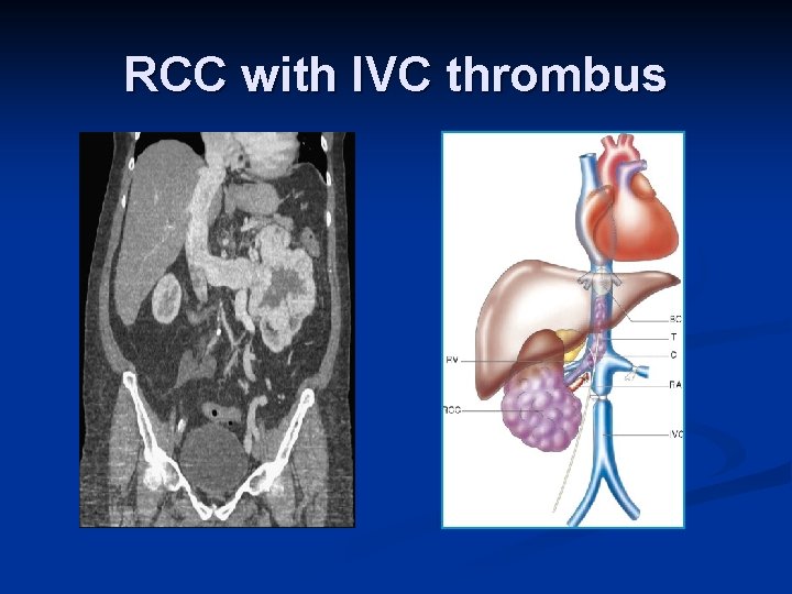 RCC with IVC thrombus 
