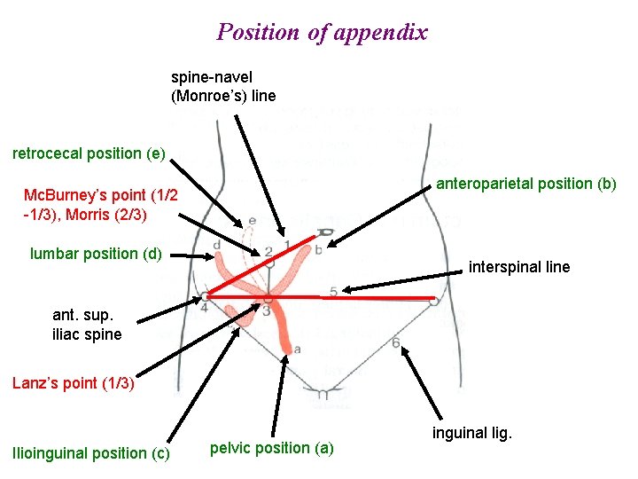Position of appendix spine-navel (Monroe’s) line retrocecal position (e) anteroparietal position (b) Mc. Burney’s Position of appendix spine-navel (Monroe’s) line retrocecal position (e) anteroparietal position (b) Mc. Burney’s