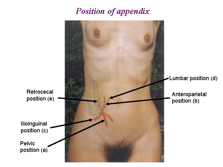 Position of appendix Lumbar position (d) Retrocecal position (e) Ilioinguinal position (c) Pelvic position Position of appendix Lumbar position (d) Retrocecal position (e) Ilioinguinal position (c) Pelvic position