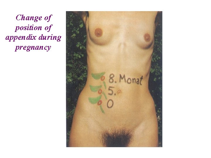 Change of position of appendix during pregnancy  Change of position of appendix during pregnancy