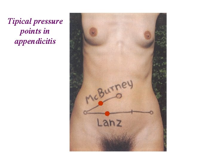 Tipical pressure points in appendicitis  Tipical pressure points in appendicitis
