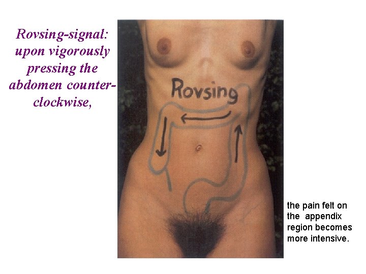 Rovsing-signal: upon vigorously pressing the abdomen counterclockwise, the pain felt on the appendix region Rovsing-signal: upon vigorously pressing the abdomen counterclockwise, the pain felt on the appendix region