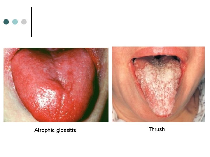 Atrophic glossitis Thrush 