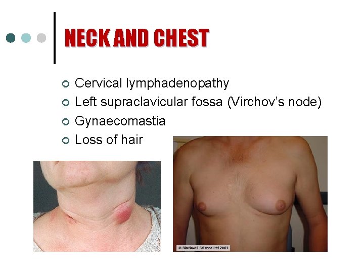 NECK AND CHEST ¢ ¢ Cervical lymphadenopathy Left supraclavicular fossa (Virchov’s node) Gynaecomastia Loss