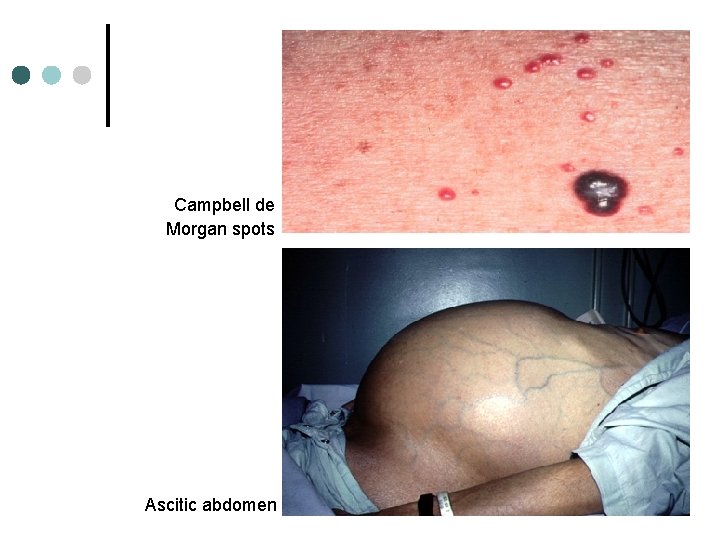 Campbell de Morgan spots Ascitic abdomen 