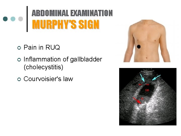 ABDOMINAL EXAMINATION MURPHY’S SIGN ¢ Pain in RUQ ¢ Inflammation of gallbladder (cholecystitis) ¢