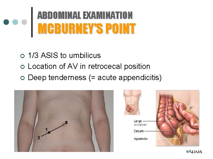 ABDOMINAL EXAMINATION MCBURNEY’S POINT ¢ ¢ ¢ 1/3 ASIS to umbilicus Location of AV