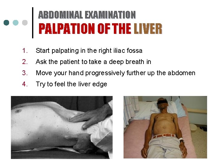 ABDOMINAL EXAMINATION PALPATION OF THE LIVER 1. Start palpating in the right iliac fossa