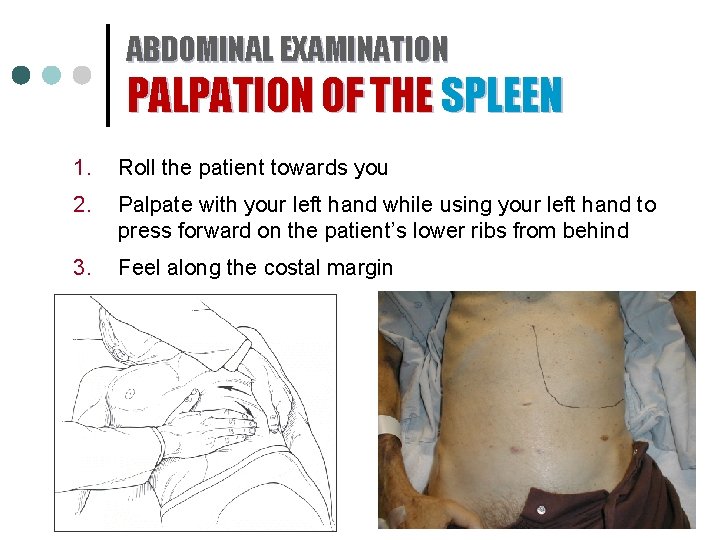 ABDOMINAL EXAMINATION PALPATION OF THE SPLEEN 1. Roll the patient towards you 2. Palpate