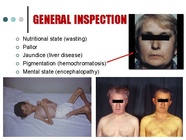 GENERAL INSPECTION ¢ ¢ ¢ Nutritional state (wasting) Pallor Jaundice (liver disease) Pigmentation (hemochromatosis)