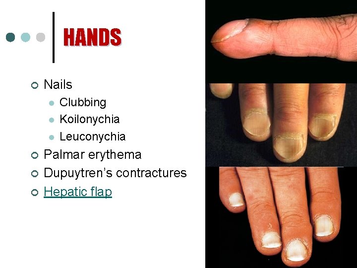 HANDS ¢ Nails l l l ¢ ¢ ¢ Clubbing Koilonychia Leuconychia Palmar erythema