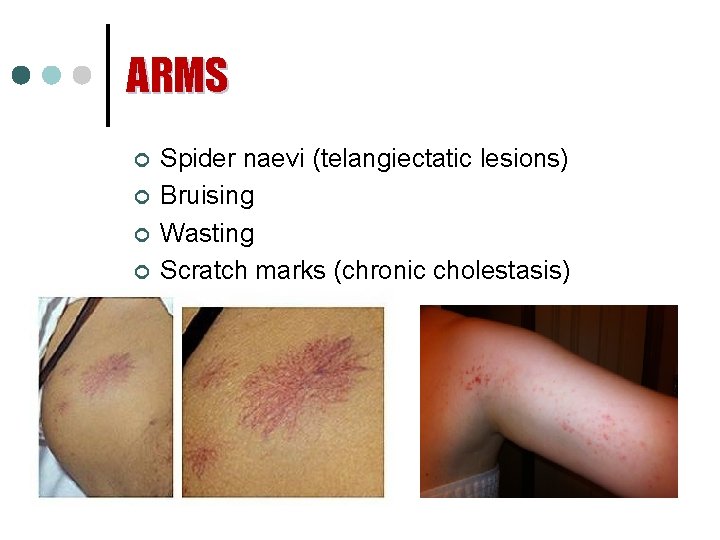 ARMS ¢ ¢ Spider naevi (telangiectatic lesions) Bruising Wasting Scratch marks (chronic cholestasis) 