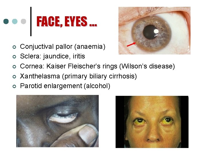 FACE, EYES … ¢ ¢ ¢ Conjuctival pallor (anaemia) Sclera: jaundice, iritis Cornea: Kaiser