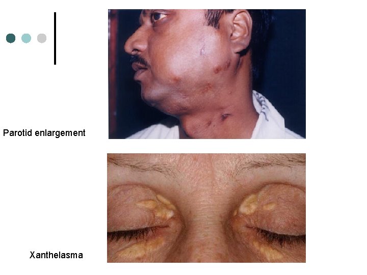 Parotid enlargement Xanthelasma 