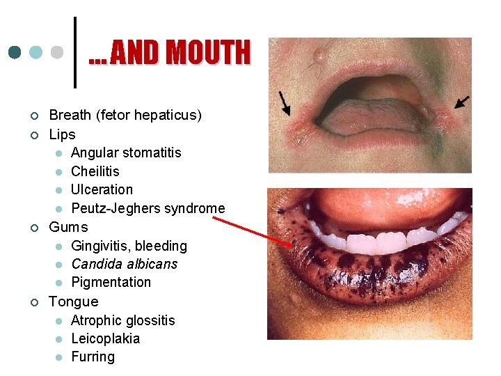 … AND MOUTH ¢ ¢ Breath (fetor hepaticus) Lips l Angular stomatitis l Cheilitis