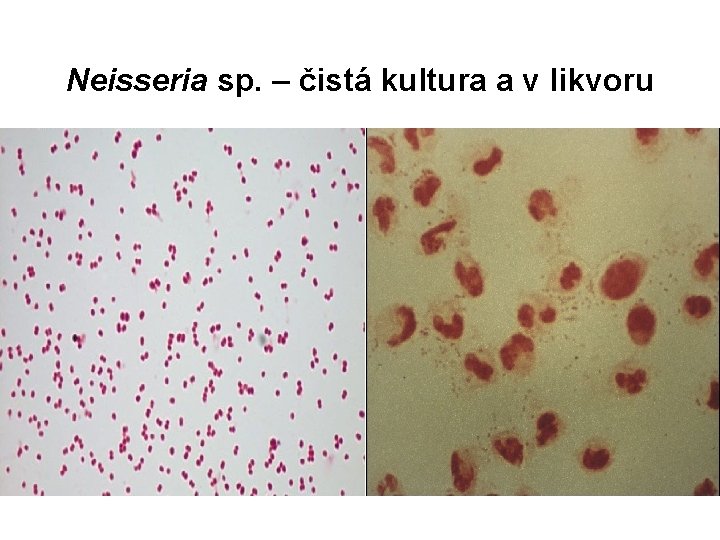 Neisseria sp. – čistá kultura a v likvoru 