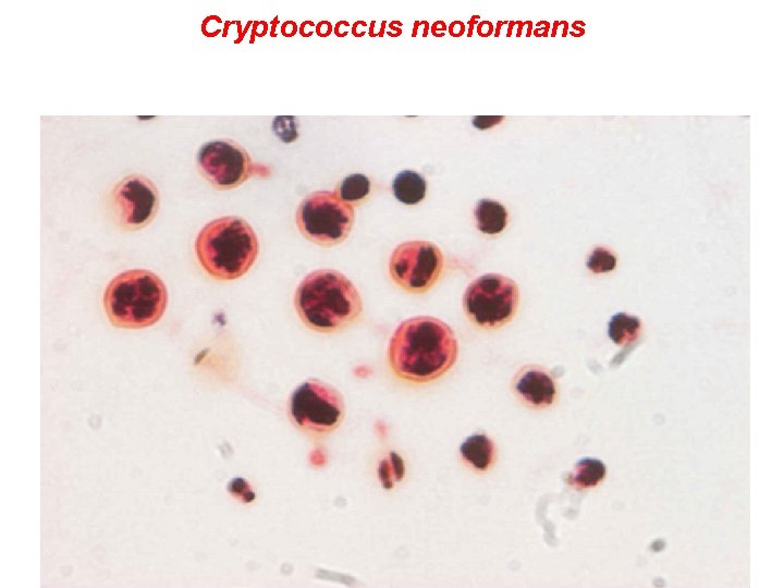 Cryptococcus neoformans v likvoru barveném dle Grama 