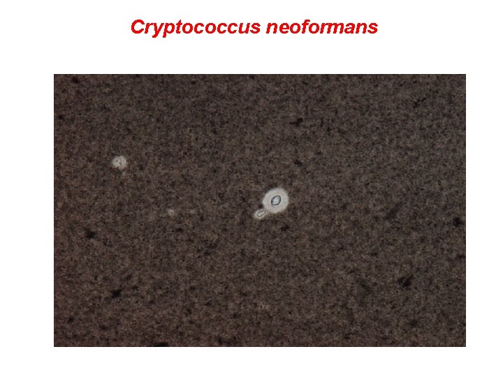Cryptococcus neoformans v likvoru -znázornění tuší 