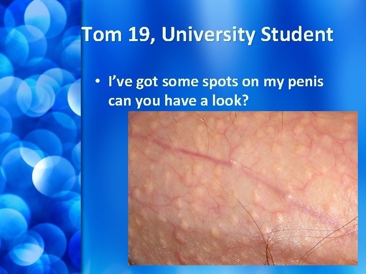 Tom 19, University Student • I’ve got some spots on my penis can you