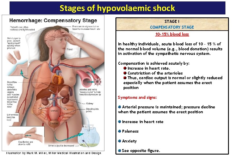 Stages of hypovolaemic shock STAGE I COMPENSATORY STAGE 10 -15% blood loss In healthy