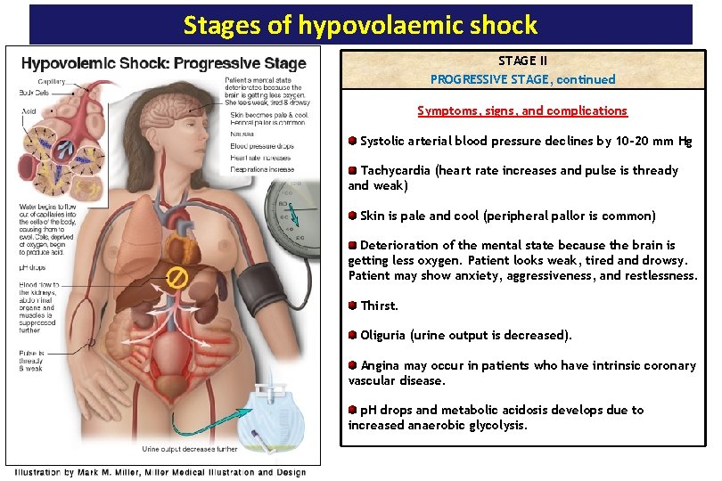 Stages of hypovolaemic shock STAGE II PROGRESSIVE STAGE, continued Symptoms, signs, and complications Systolic