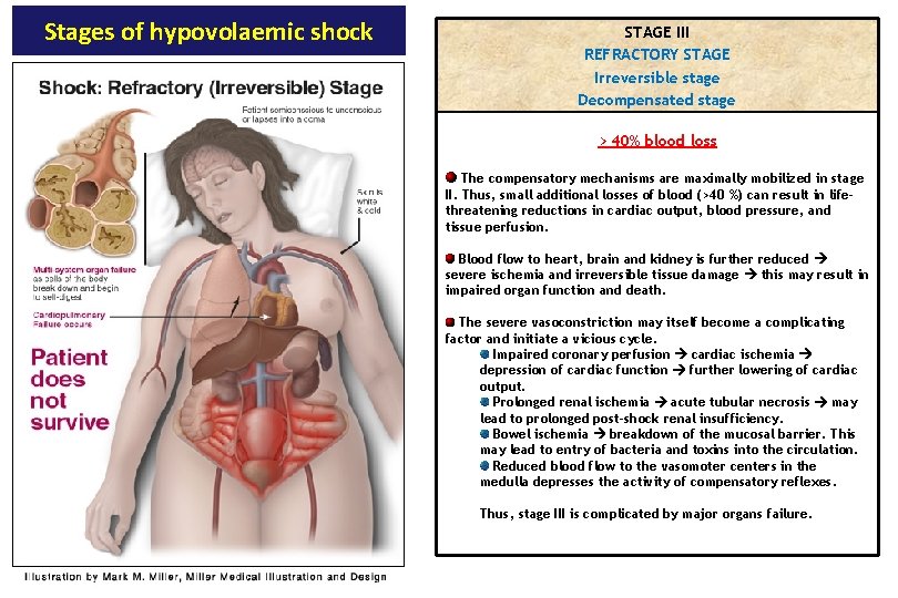 Stages of hypovolaemic shock STAGE III REFRACTORY STAGE Irreversible stage Decompensated stage > 40%