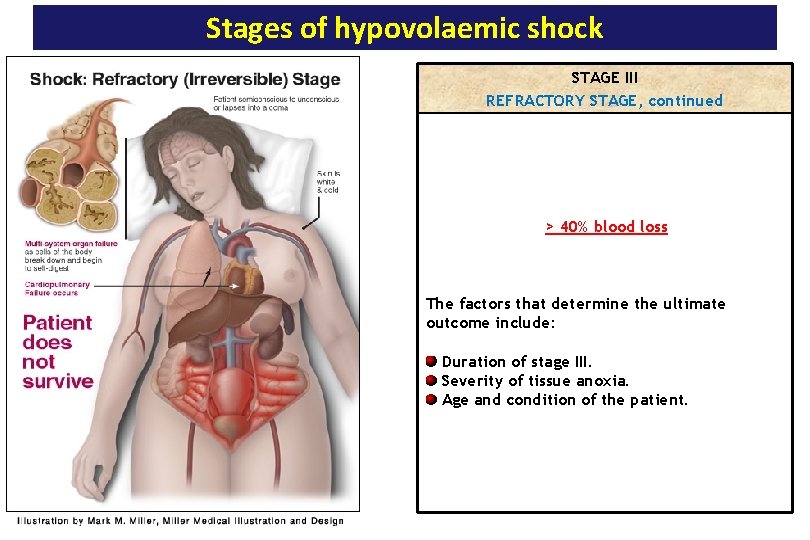 Stages of hypovolaemic shock STAGE III REFRACTORY STAGE, continued > 40% blood loss The