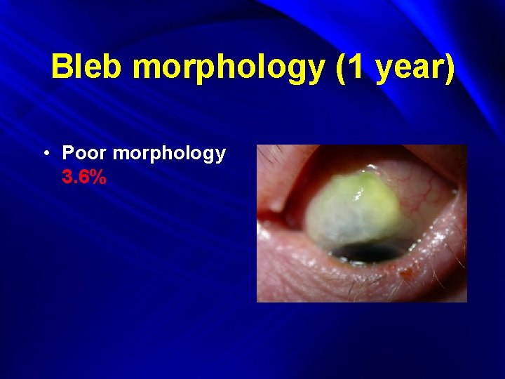 Bleb morphology (1 year) • Poor morphology 3. 6% 