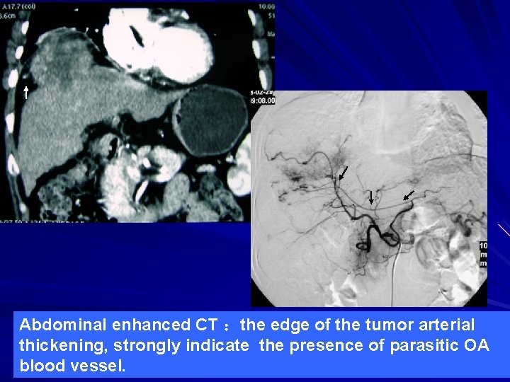 Abdominal enhanced CT ：the edge of the tumor arterial thickening, strongly indicate the presence