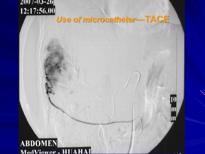 Use of microcatheter—TACE 