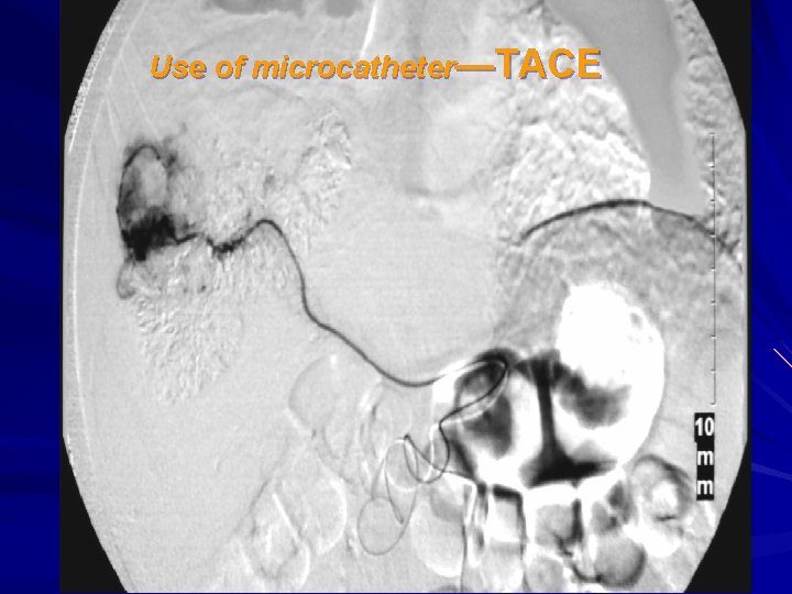 Use of microcatheter—TACE 