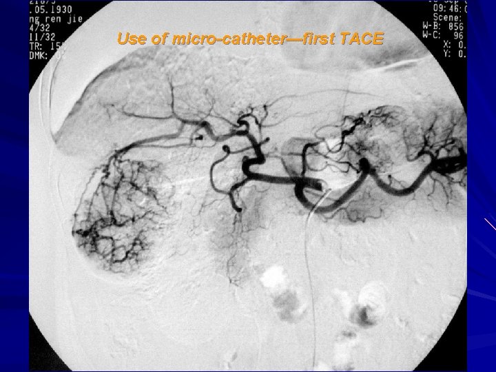 Use of micro-catheter—first TACE 