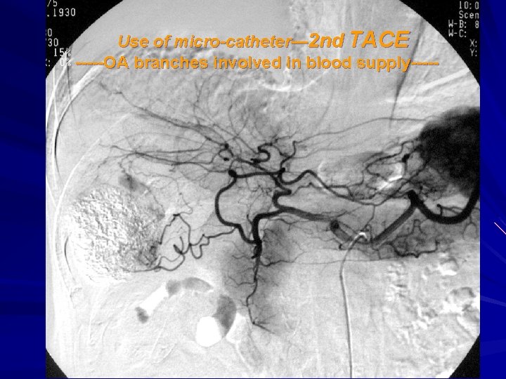 Use of micro-catheter— 2 nd TACE -----OA branches involved in blood supply----- 