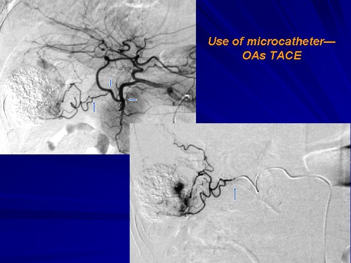 Use of microcatheter— OAs TACE 