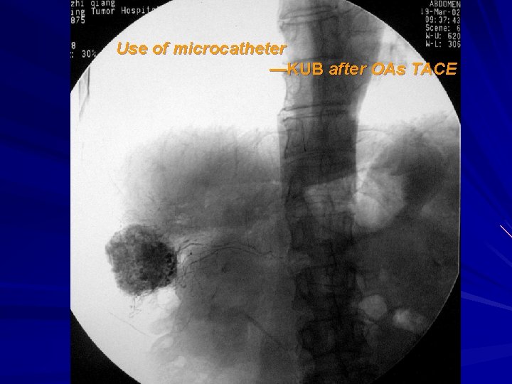 Use of microcatheter —KUB after OAs TACE 