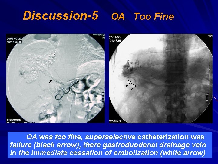 Discussion-5 OA Too Fine OA was too fine, superselective catheterization was failure (black arrow),