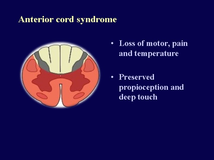 Anterior cord syndrome • Loss of motor, pain and temperature • Preserved propioception and
