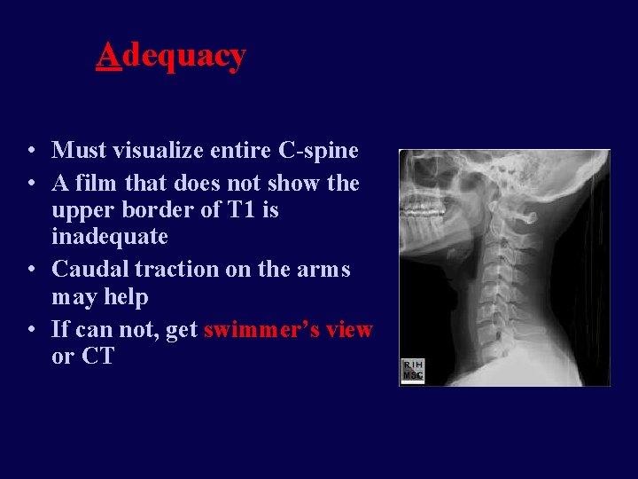 Adequacy • Must visualize entire C-spine • A film that does not show the