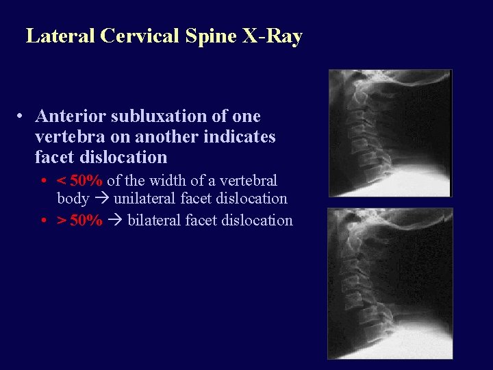 Lateral Cervical Spine X-Ray • Anterior subluxation of one vertebra on another indicates facet