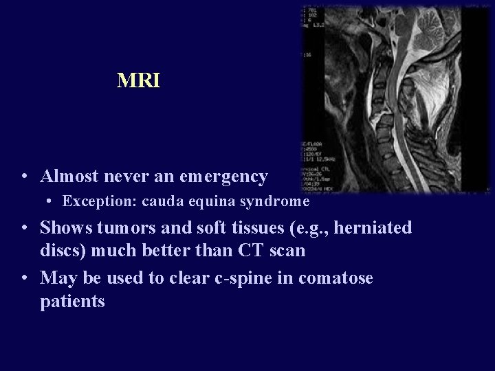 MRI • Almost never an emergency • Exception: cauda equina syndrome • Shows tumors