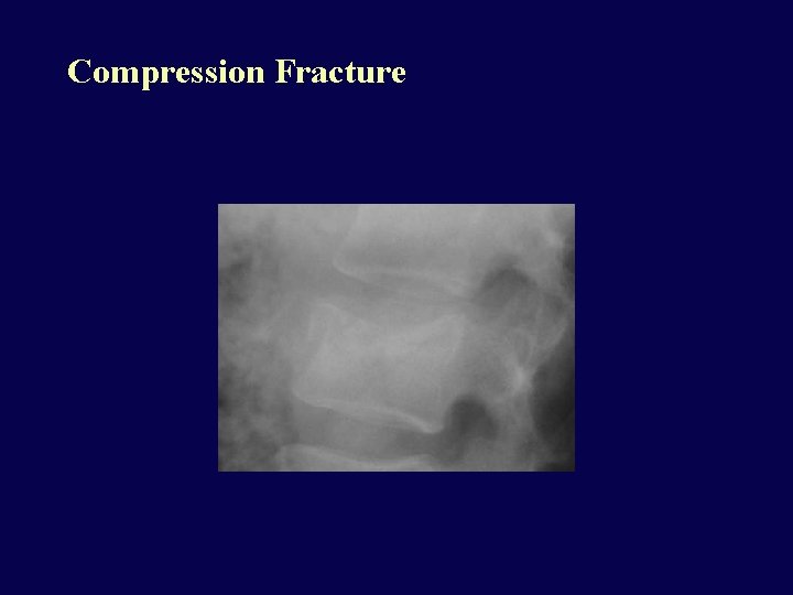 Compression Fracture 