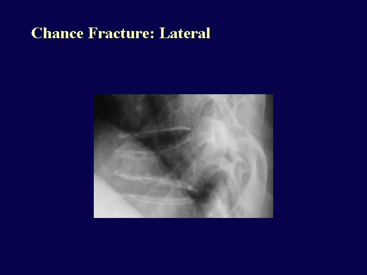 Chance Fracture: Lateral 