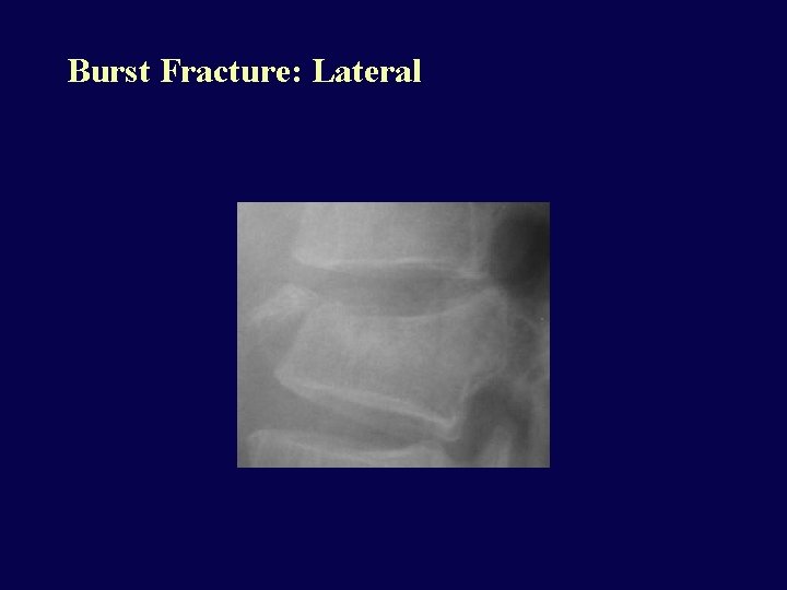 Burst Fracture: Lateral 