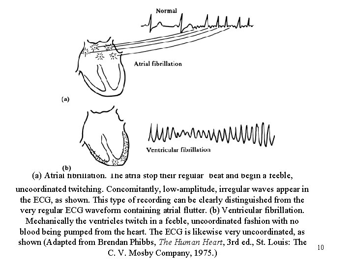  (a) Atrial fibrillation. The atria stop their regular beat and begin a feeble,