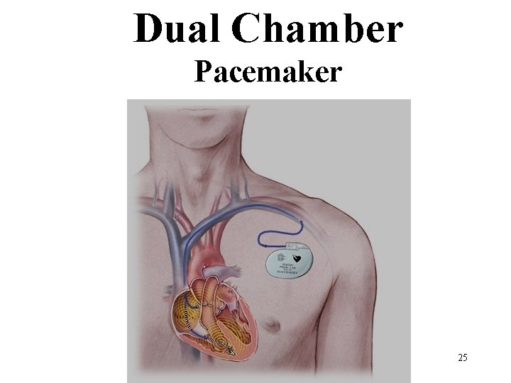 Dual Chamber Pacemaker 25 