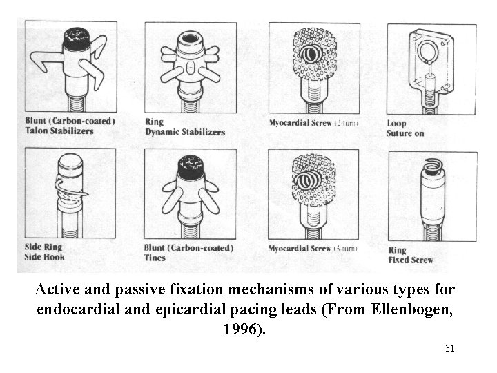  Active and passive fixation mechanisms of various types for endocardial and epicardial pacing