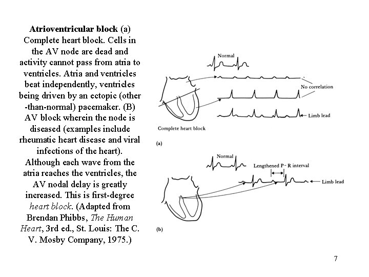 Atrioventricular block (a) Complete heart block. Cells in the AV node are dead and