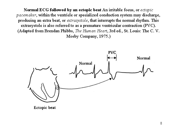 Normal ECG followed by an ectopic beat An irritable focus, or ectopic pacemaker, within