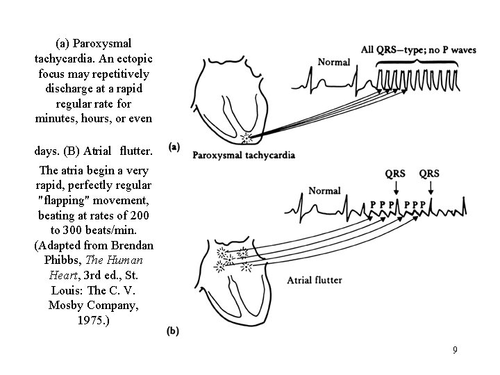 (a) Paroxysmal tachycardia. An ectopic focus may repetitively discharge at a rapid regular rate
